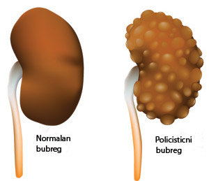 policisticni-bubrezi