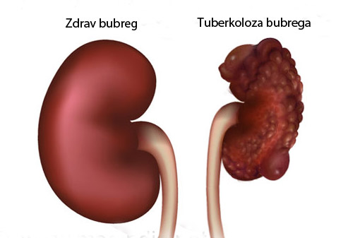 tuberkoloza-bubrega
