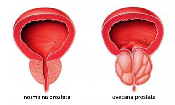 adenom prostate simptomi